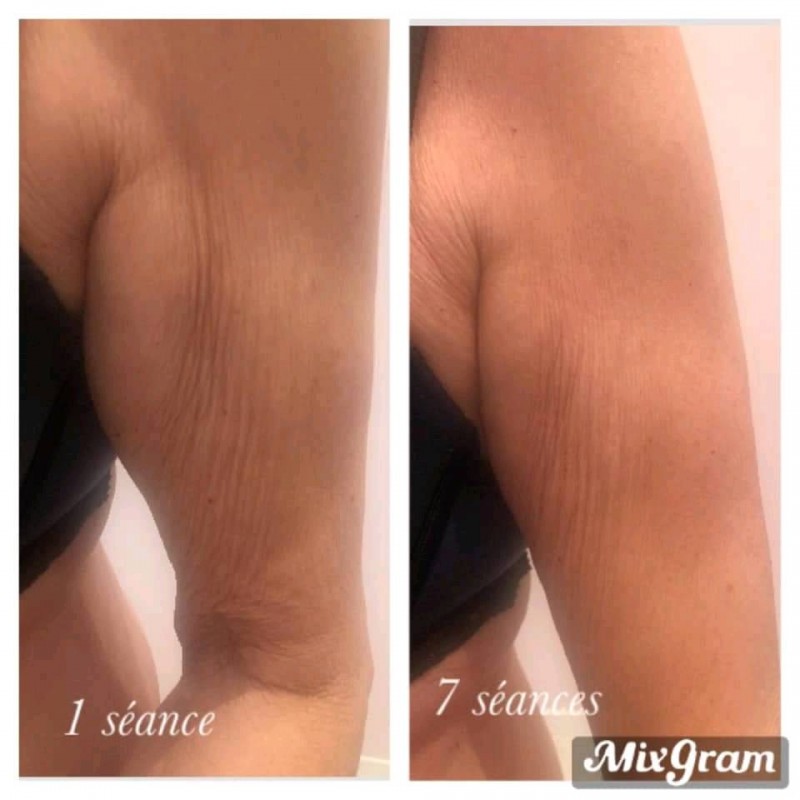 résultat raffermissant bras, vsthetica, martigues forfait à petit prix,