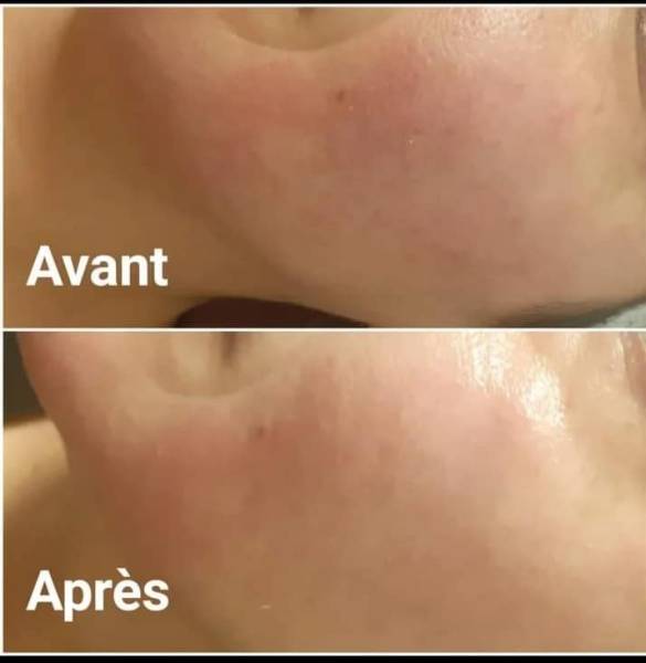 soin adapté aux peaux rougeurs, irritées, sèches en institut de beauté à Martigues 