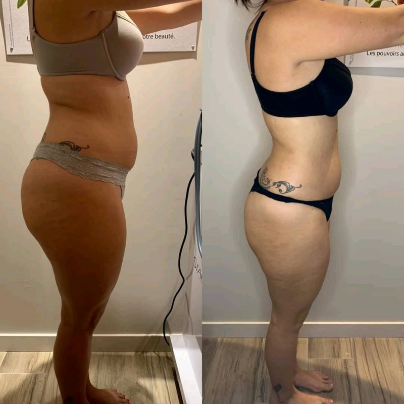 soin minceur et raffermissant autour de port de bouc, stretching cellulaire