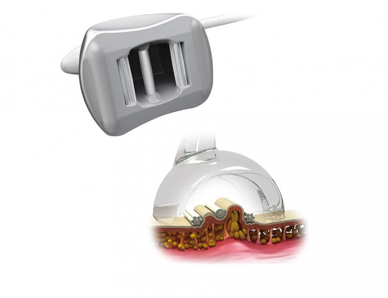 palper-rouer, double pli de peau, anti-cellulite, minceur, petit prix, indolore