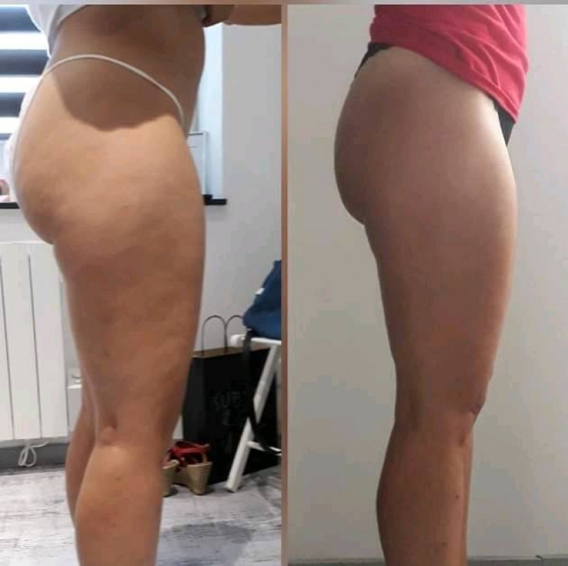 soin anti cellulite, séance découverte sur martigues dans votre institut vsthetica