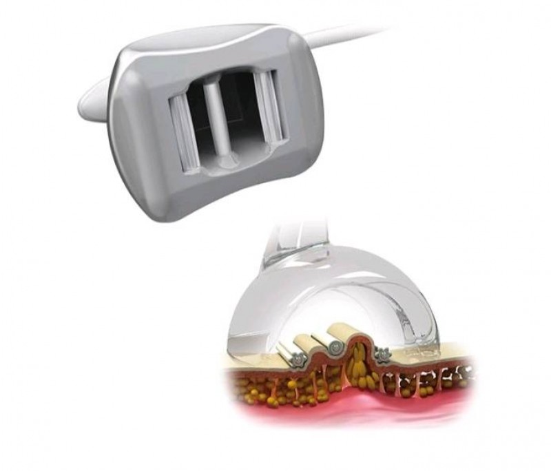 dxlight starvac, technologie, palper-rouler, fermeté, soin minceur, forfait anti-ride