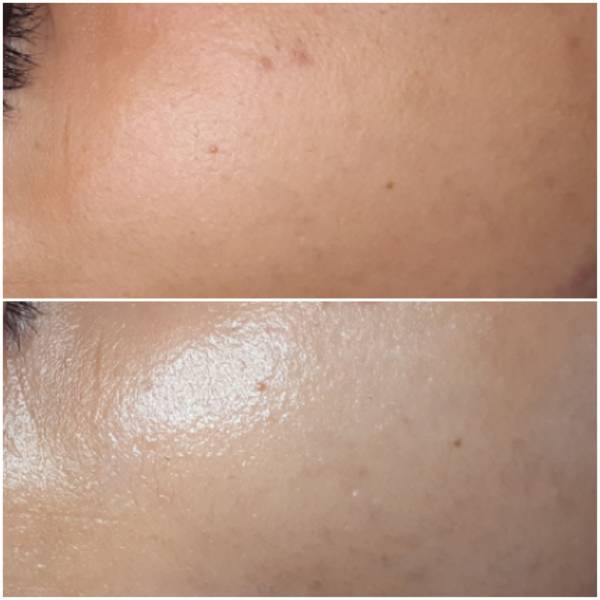 soin du visage pores dilatés, acnés, boutons, micro enfermement, cicatrices, Dr Reiner  Janka